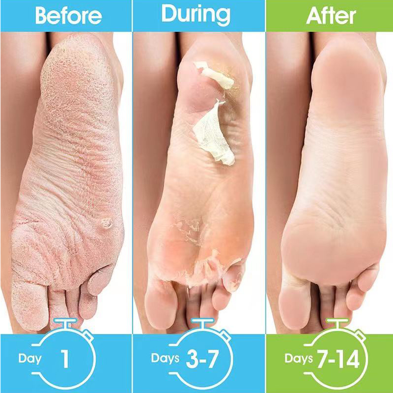 1팩=1쌍 허니 풋 마스크 각질 제거, 굳은살 제거,  - Foot Mask Peeling 리뷰 및 가격