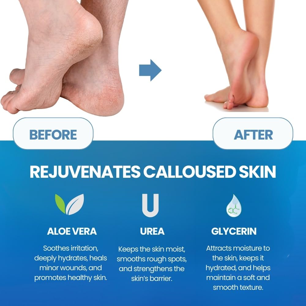 발 각질 제거제, 발 각질 연화제, 굳은살 제거, 발  - Foot Mask Peeling 리뷰 및 가격